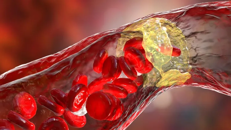 无斑块高危糖友,用这种药少三成心梗风险