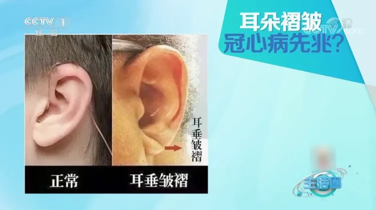 耳垂上一道斜褶,把冠状动脉的堵塞信号写在了脸上